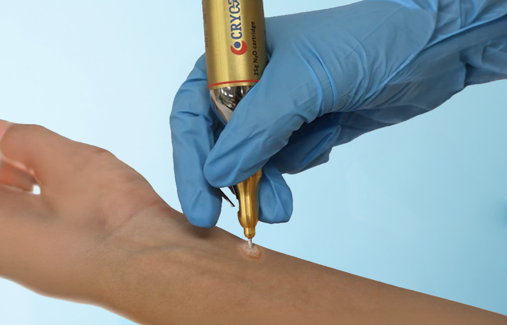 Cryotherapy & CryoPen Training